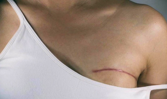 Lumpectomy Breast-Conserving Surgery