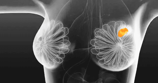 best breast lump specialist in borivali